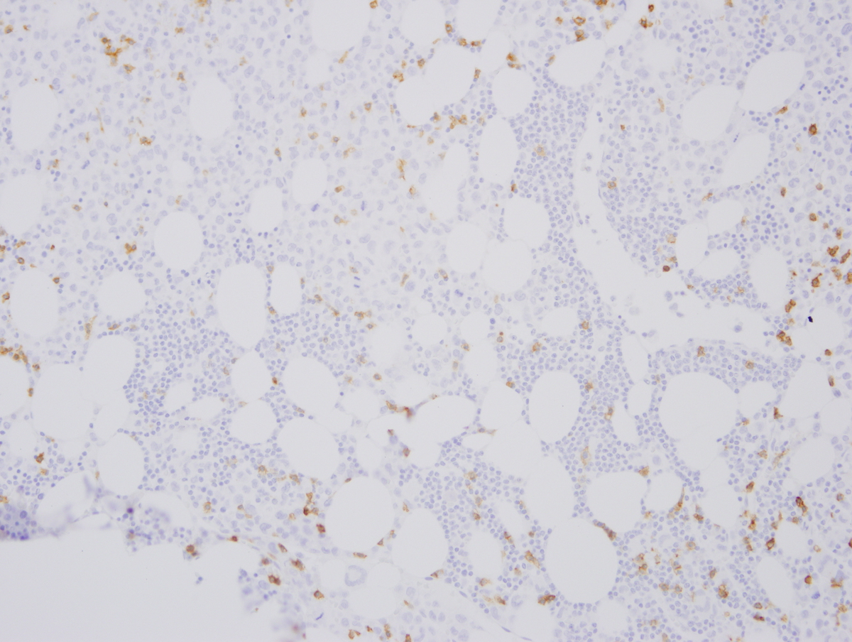 Fig. 9 Bone marrow core biopsy. Ill-defined interstitial lymphoid aggregates composed of small mature appearing lymphocytes are noted in addition to the blasts (Fig. 9a). The lymphocytes are positive for CD20 (Fig. 9b) and CD5 (Fig. 9c) by immunohistochemistry. CD3 (Fig. 9d) highlights scattered T-cells.